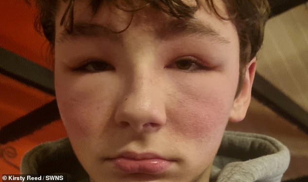 Lewis suffered a rare allergic reaction after using Facebook's Oculus Quest 2 virtual reality headset, which caused the skin on his face to swell and turn red